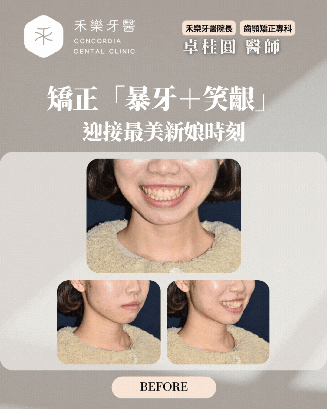 https://www.givemepower.net/wp-content/uploads/2025/12/禾樂矯正案例-迎接最美新娘時刻.gif